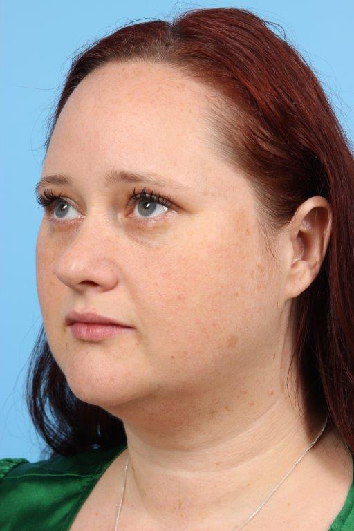 Neck Liposuction Before and After 11