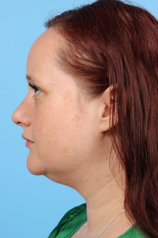 Neck Liposuction Before and After 11
