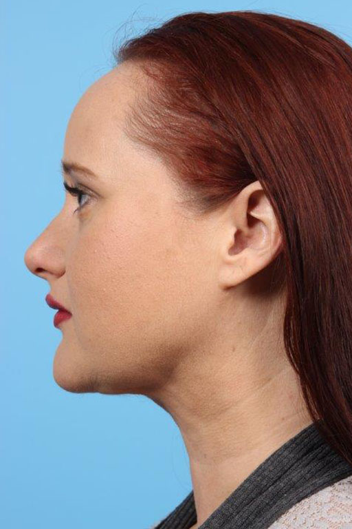 Neck Liposuction Before and After 11