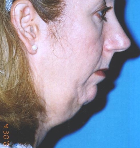 Necklift Before and After 14
