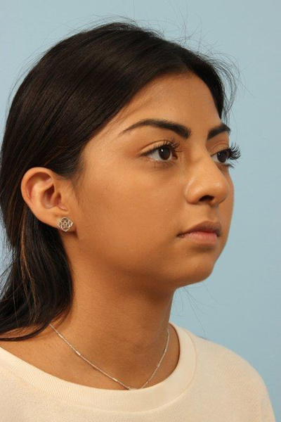 Non Surgical Rhinoplasty Before and After 03