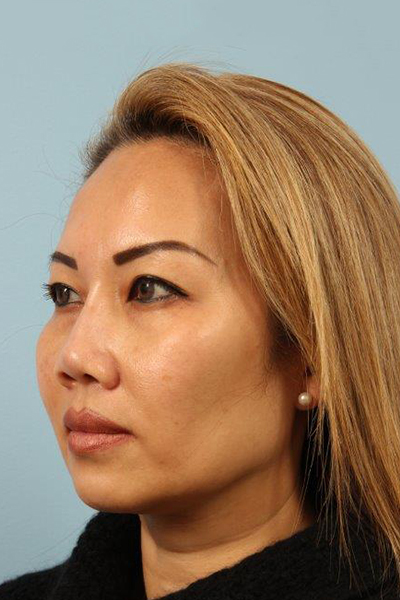 Non Surgical Rhinoplasty Before and After 02