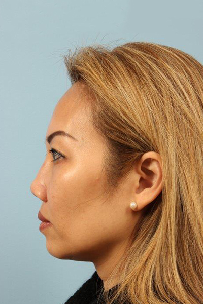Non Surgical Rhinoplasty Before and After 02