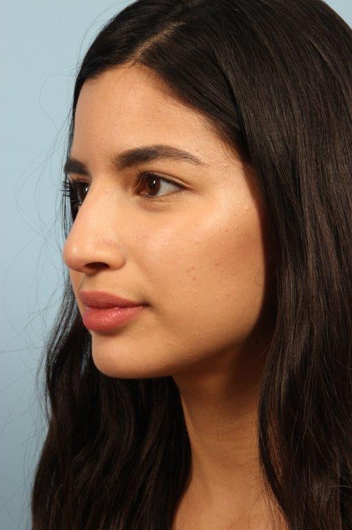 Non Surgical Rhinoplasty Before and After 01