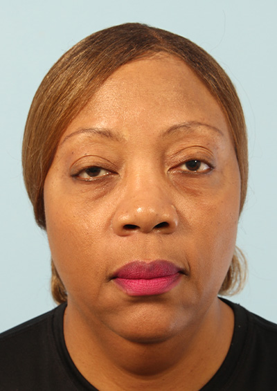 Paradoxical Adipose Hyperplasia (PAH) Before and After 01