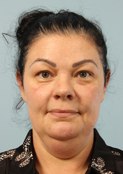 Paradoxical Adipose Hyperplasia (PAH) Before and After 02