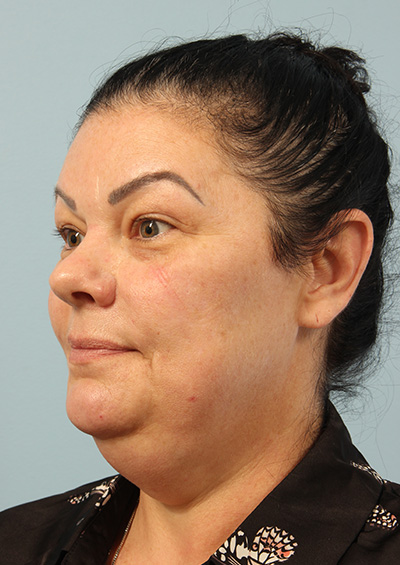 Paradoxical Adipose Hyperplasia (PAH) Before and After 02