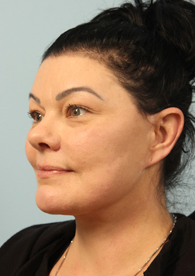 Paradoxical Adipose Hyperplasia (PAH) Before and After 02