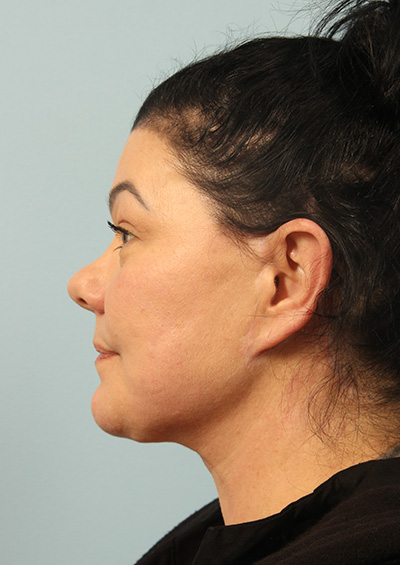 Paradoxical Adipose Hyperplasia (PAH) Before and After 02