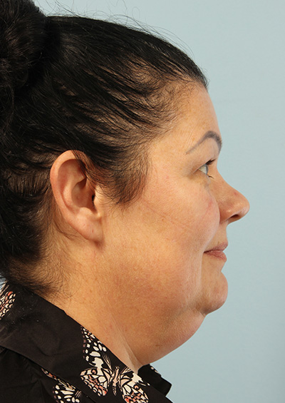 Paradoxical Adipose Hyperplasia (PAH) Before and After 02