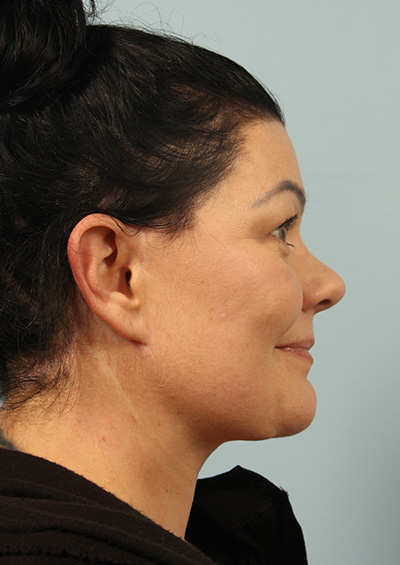 Paradoxical Adipose Hyperplasia (PAH) Before and After 02