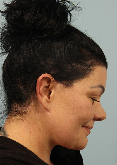 Paradoxical Adipose Hyperplasia (PAH) Before and After 02