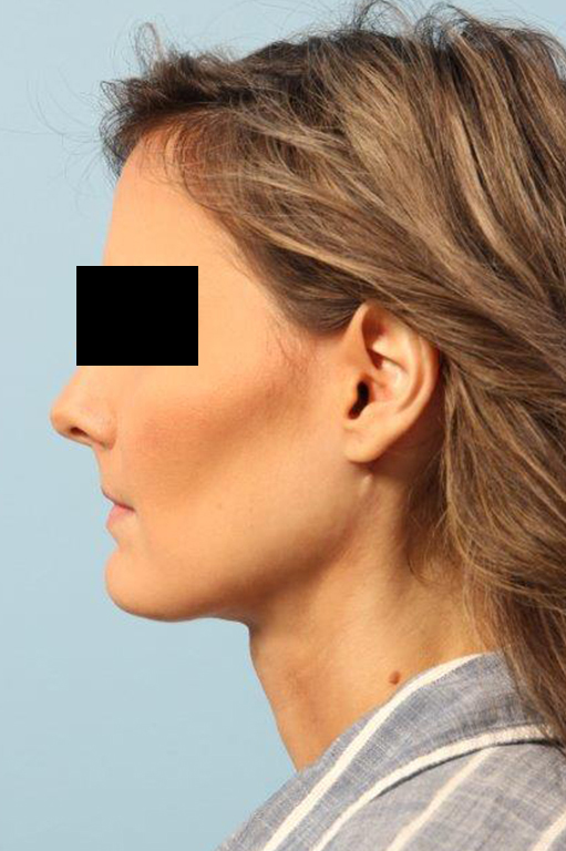 Renuvion Jplasma Neck Contouring Before and After 01