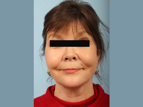 Renuvion Jplasma Neck Contouring Before and After 03
