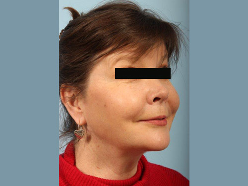 Renuvion Jplasma Neck Contouring Before and After 02