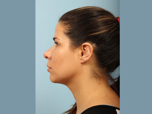 Renuvion Jplasma Neck Contouring Before and After 05