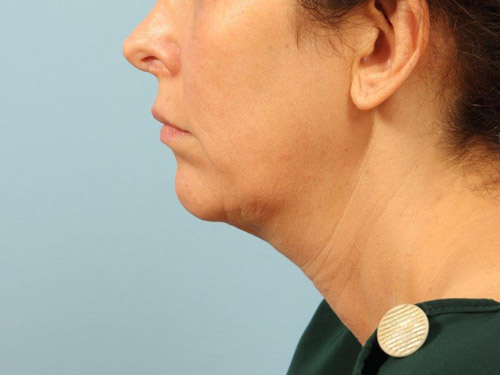 Renuvion Jplasma Neck Contouring Before and After 06