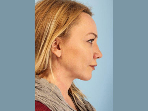 Renuvion Jplasma Neck Contouring Before and After 08