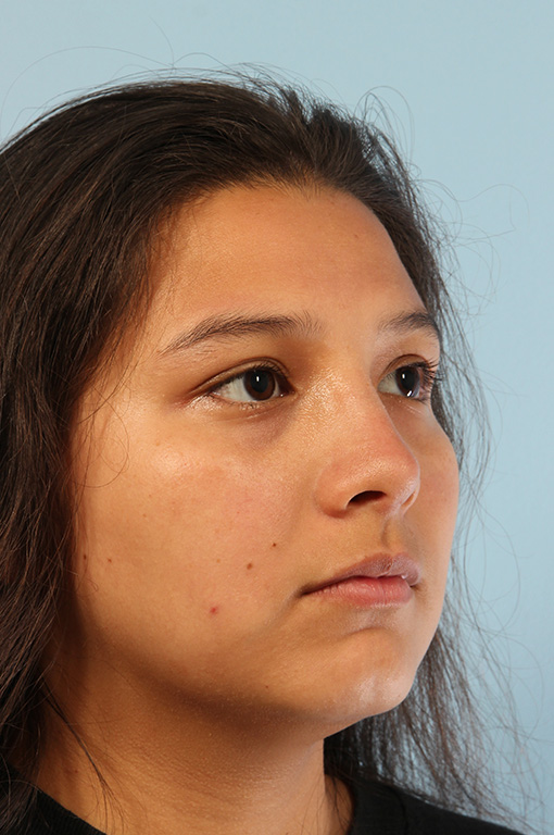 Rhinoplasty Before and After 15