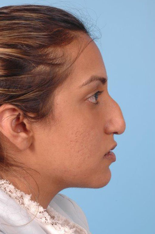 Rhinoplasty Before and After 10