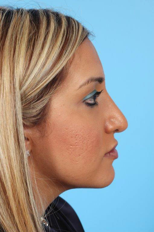 Rhinoplasty Before and After 10