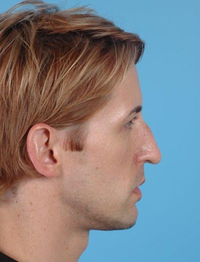 Rhinoplasty Before and After 12