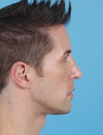 Rhinoplasty Before and After 12