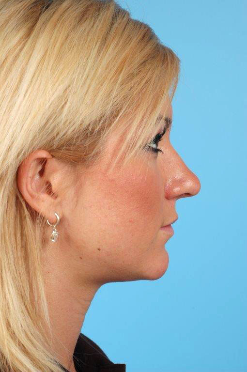 Rhinoplasty Before and After 13