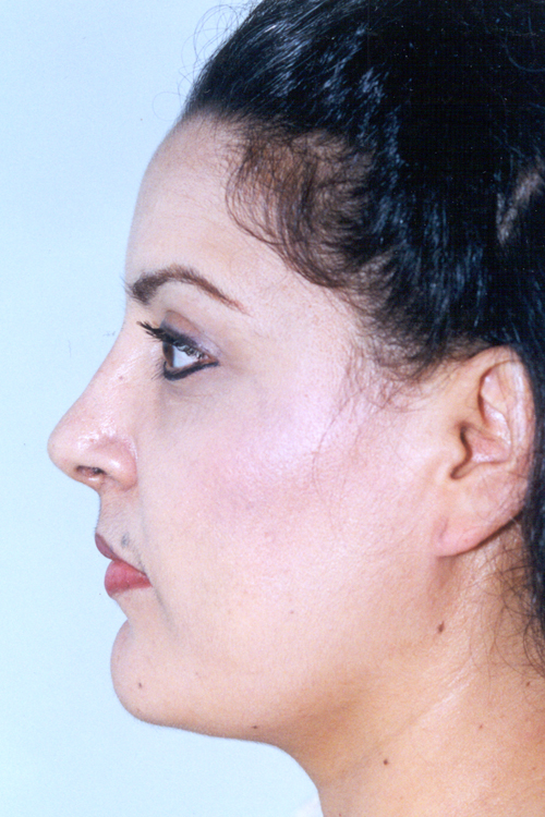 Rhinoplasty Before and After 07