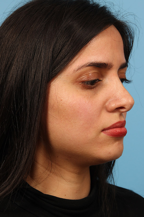 Rhinoplasty Before and After 14