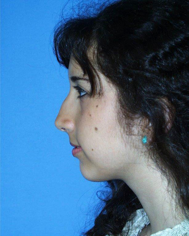 Rhinoplasty Before and After 19