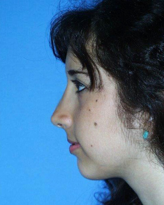 Rhinoplasty Before and After 19