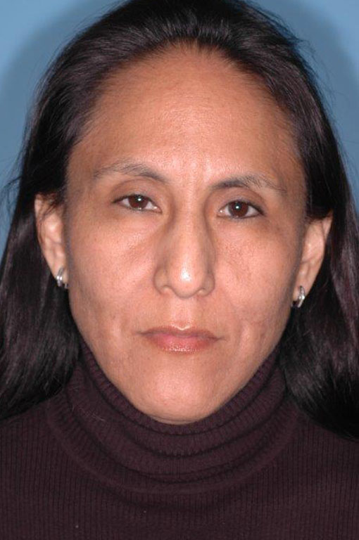 Rhinoplasty Before and After 20