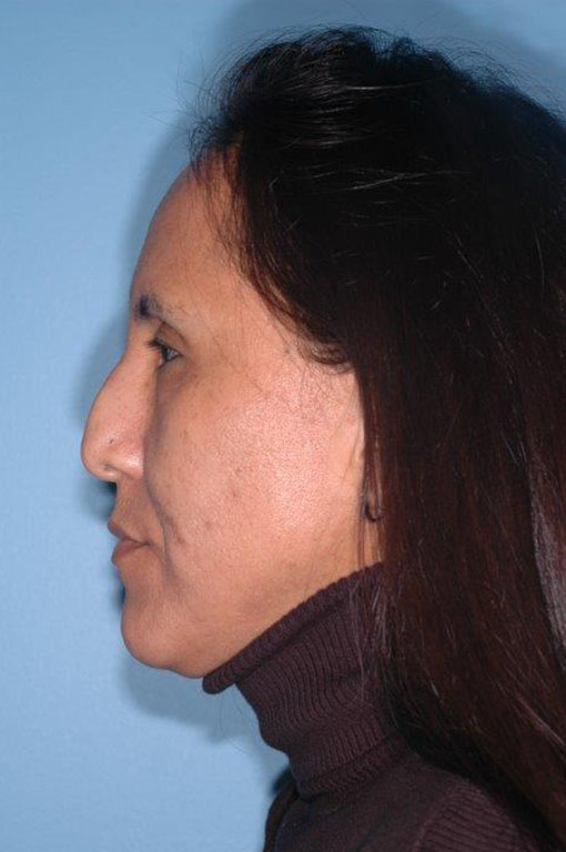 Rhinoplasty Before and After 20