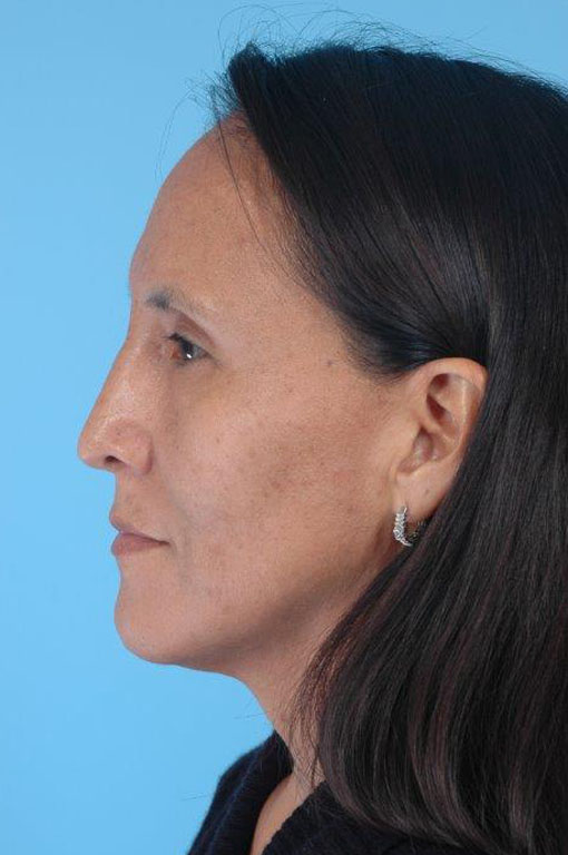 Rhinoplasty Before and After 20