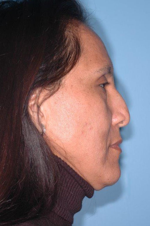 Rhinoplasty Before and After 20