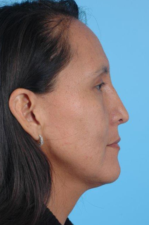 Rhinoplasty Before and After 20