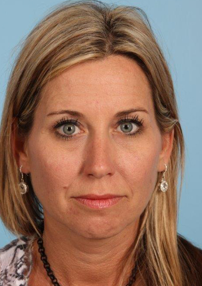 Fillers Before and After 01