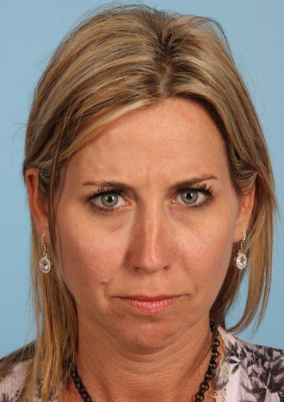 Fillers Before and After 01