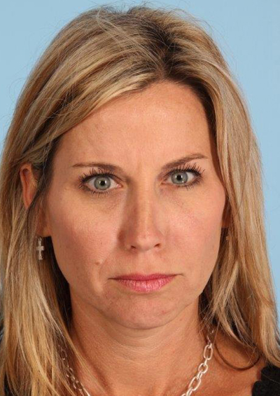 Fillers Before and After 01