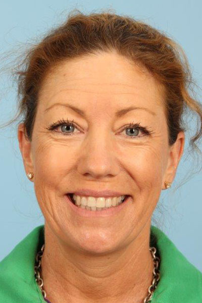 Fillers Before and After 02