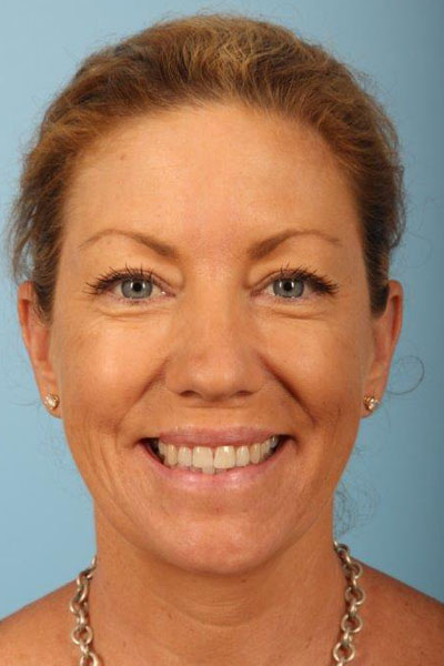 Fillers Before and After 01