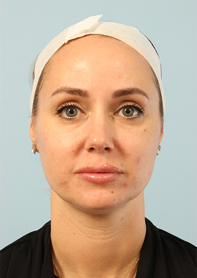 Neurotoxin Before and After 01