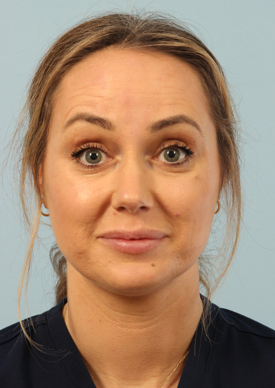 Neurotoxin Before and After 01