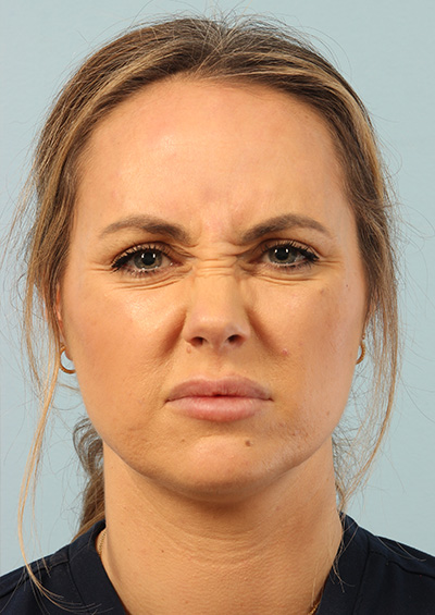 Neurotoxin Before and After 01