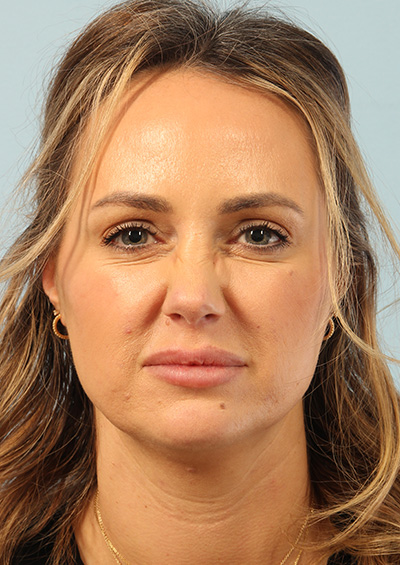 Neurotoxin Before and After 01