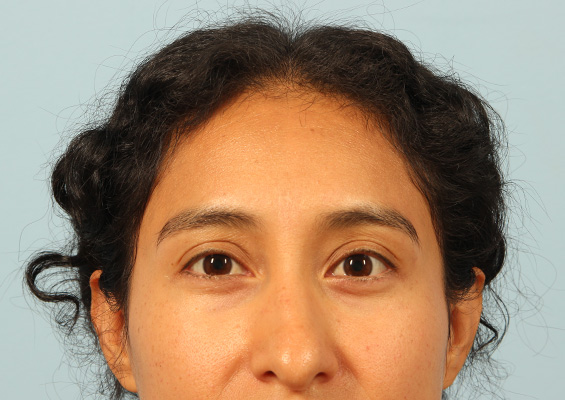 Neurotoxin Before and After 02