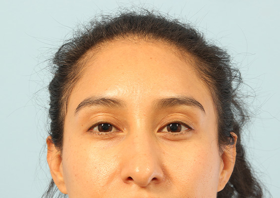 Neurotoxin Before and After 01