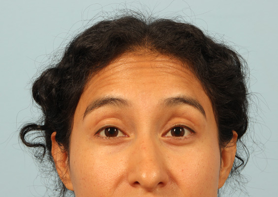 Neurotoxin Before and After 02