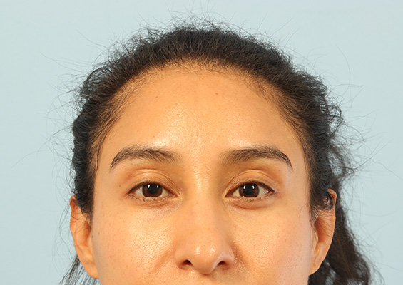 Neurotoxin Before and After 02